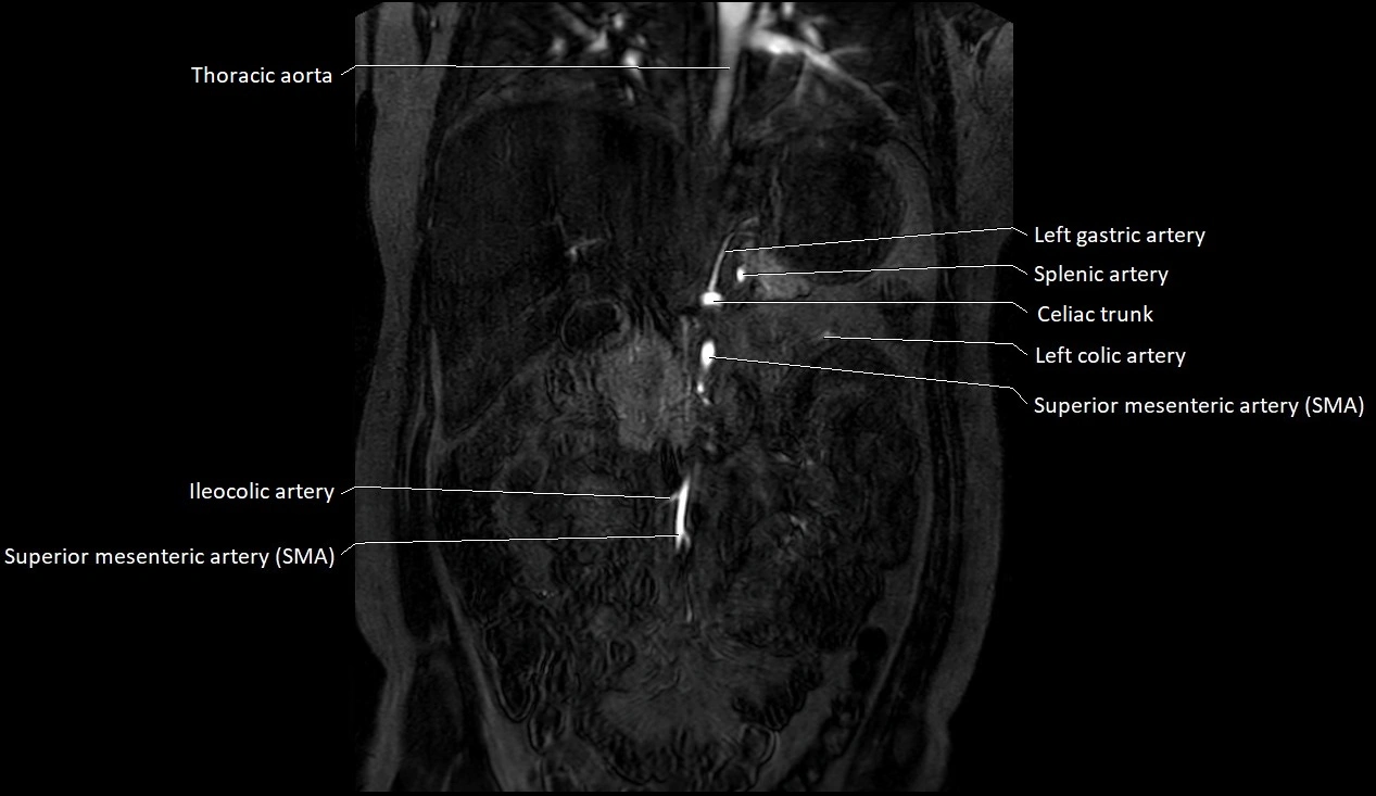 MRA Abdomen coronal anatomy image 10.webp